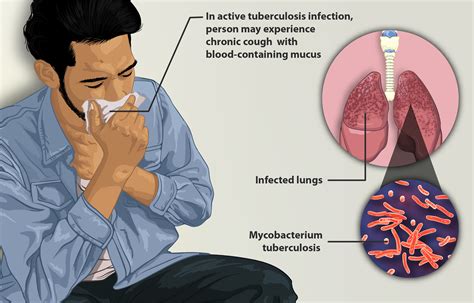 bad tb|Tuberculosis (TB): Causes, Symptoms, Treatment